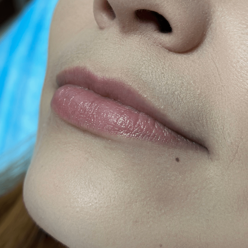 Antes relleno de ácido hialurónico labios San Carlos