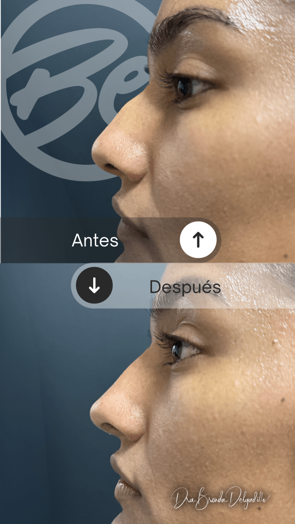 Antes y despues Rinomodelacion San Carlos